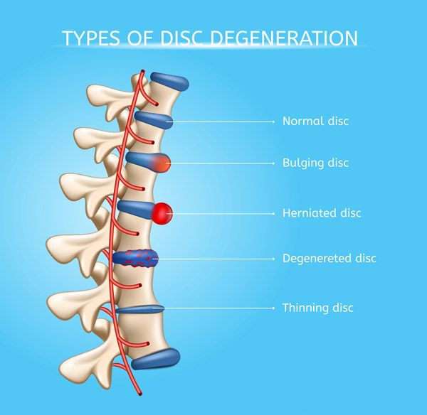 Spinal Decompression West Michigan Chiropractor